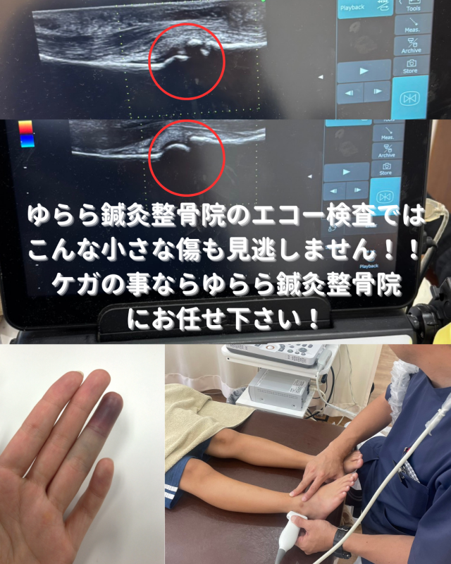 【突き指の真実】痛みや腫れが引かない時は、骨折や腱の断裂かもしれません！